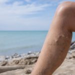 When Is The Best Time To Treat Leg Veins?