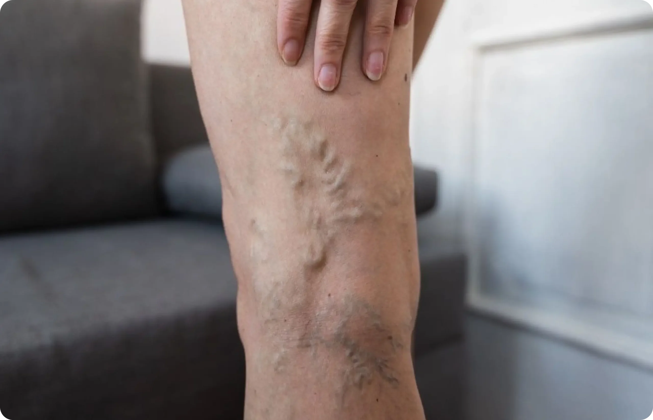 Leg veins treatment
