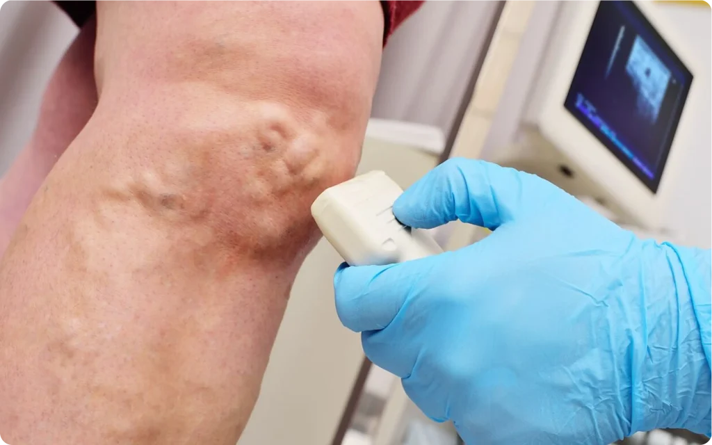 An Image of a person's leg being scanned with ultra sound to assess their varicose veins condition. Blog image for melbournelegveincentre.
