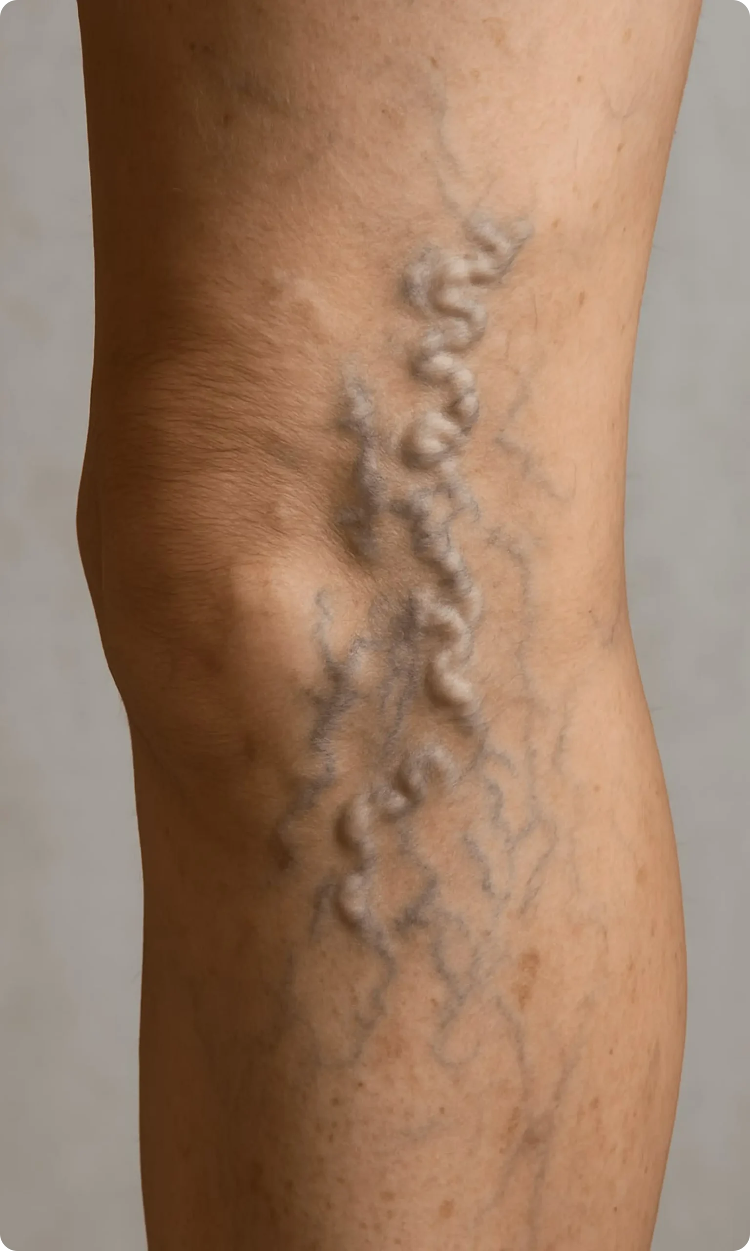 Bulging varicose vein on leg