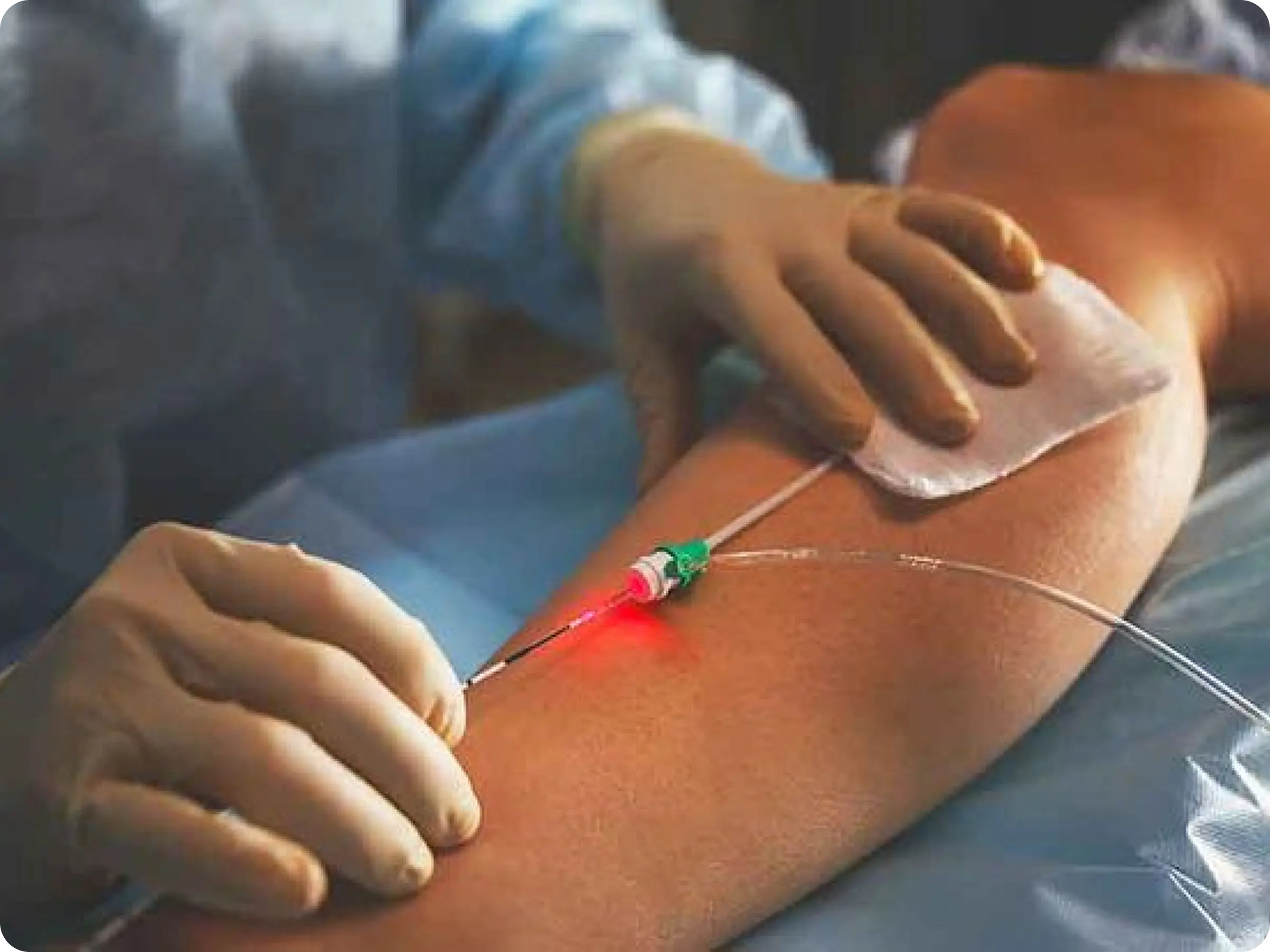 What is endovenous laser ablation?
