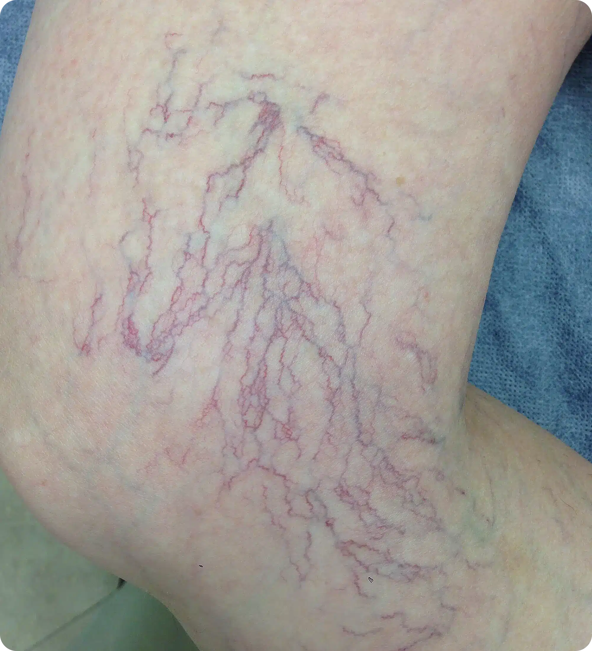 Close-up of telangiectasia