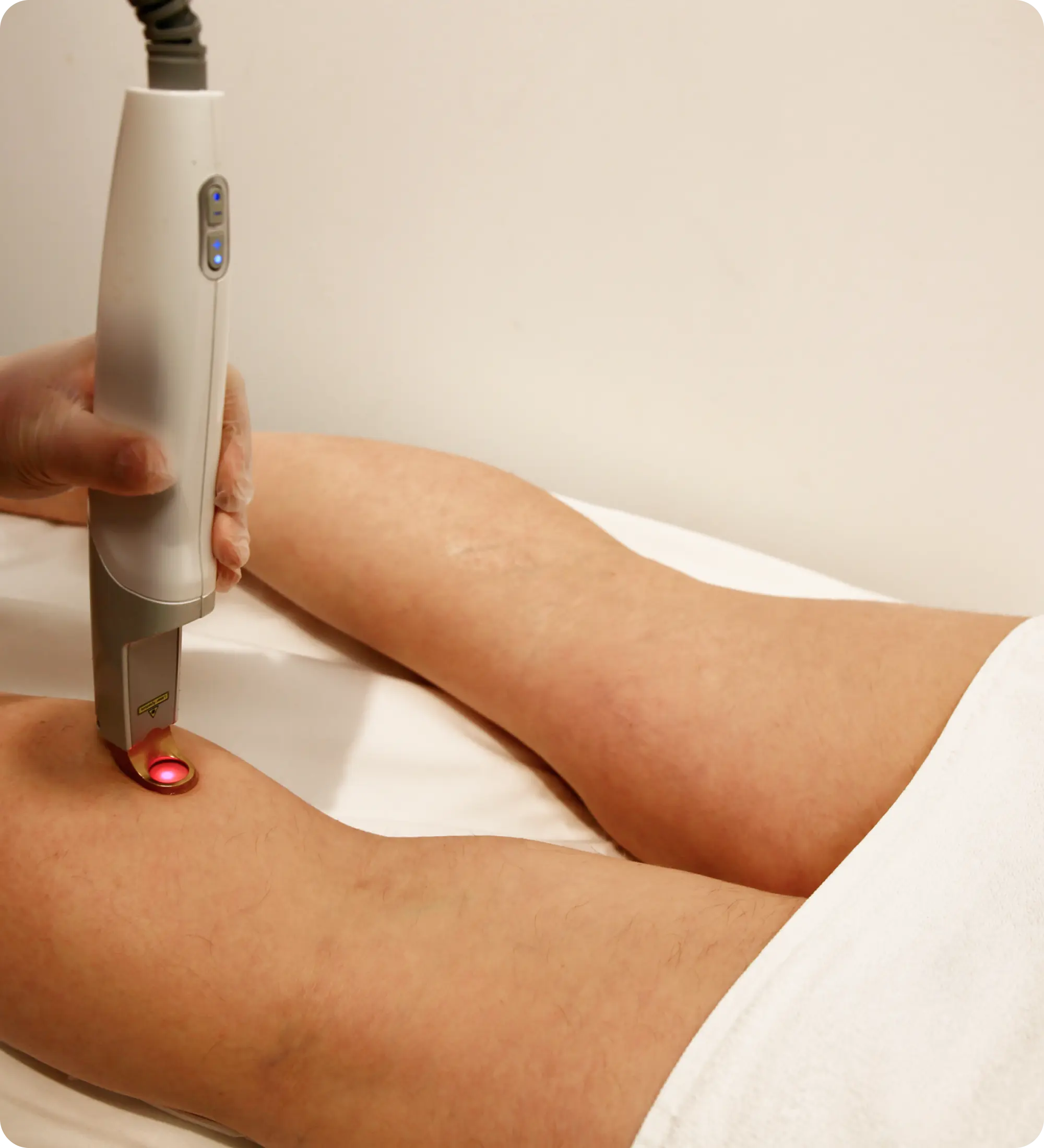 Telangiectasia treatment results