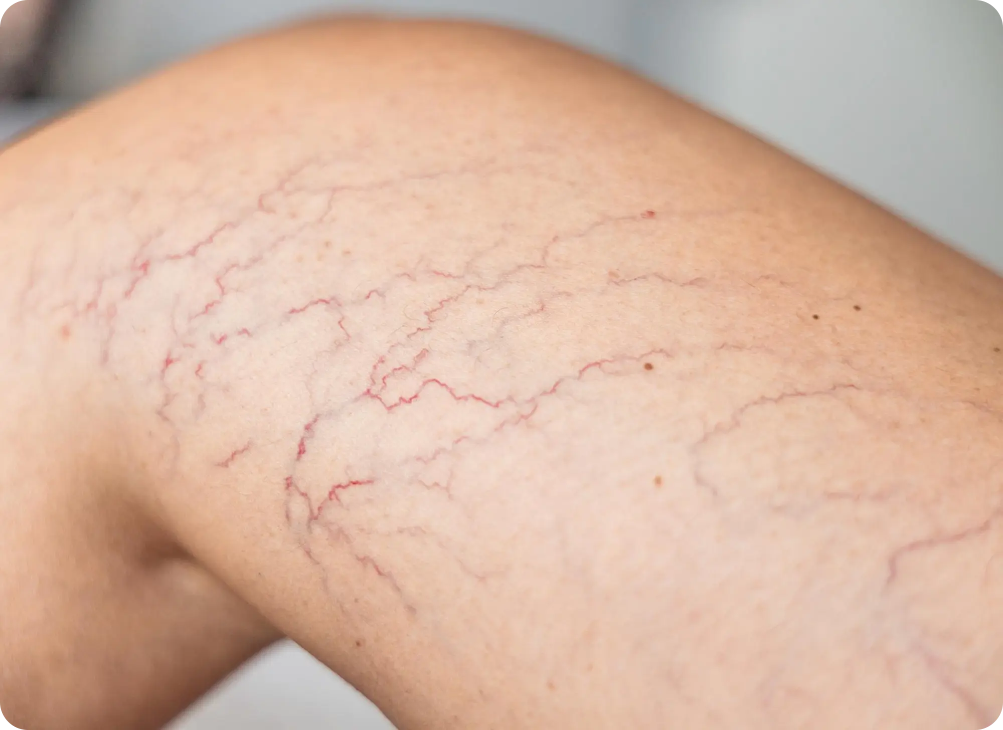 Fine red telangiectasia on the leg