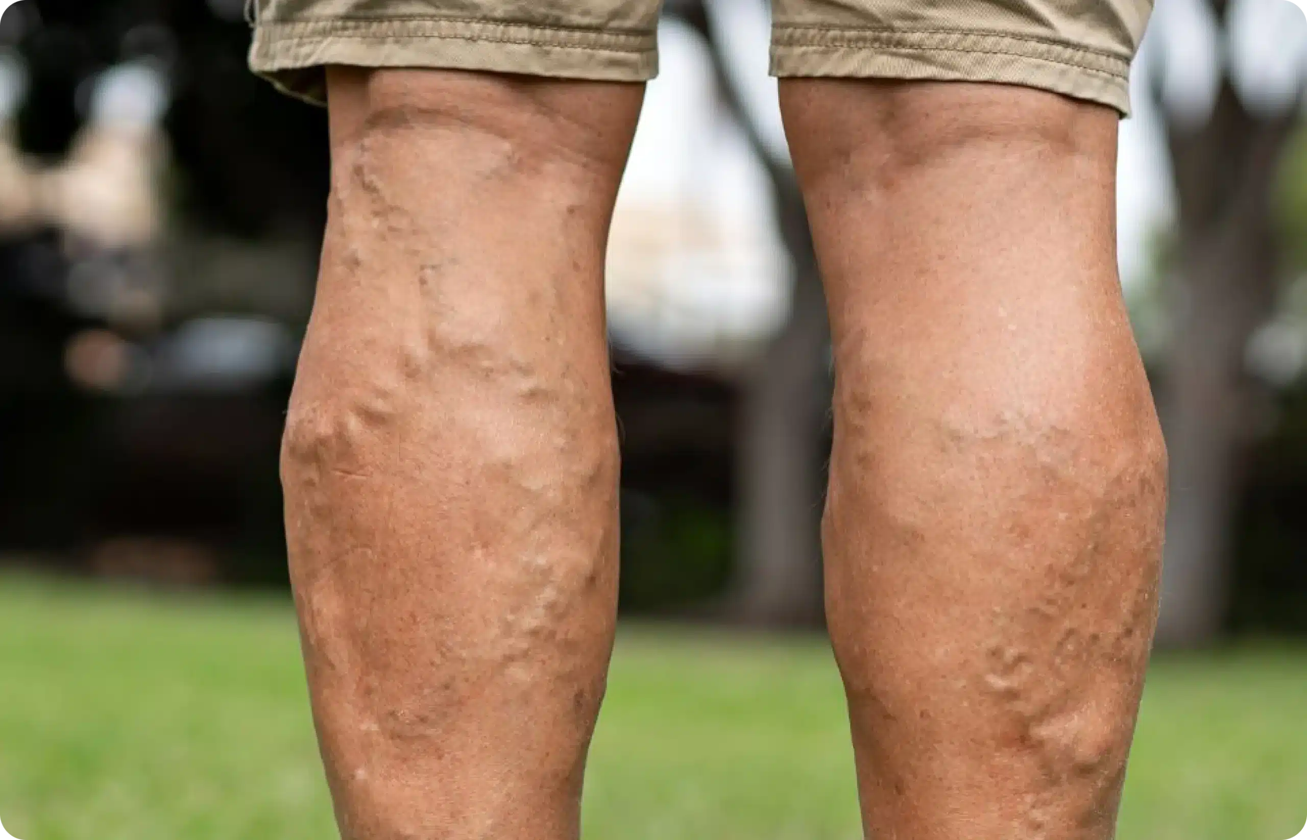 Varicose veins on legs showing bulging appearance