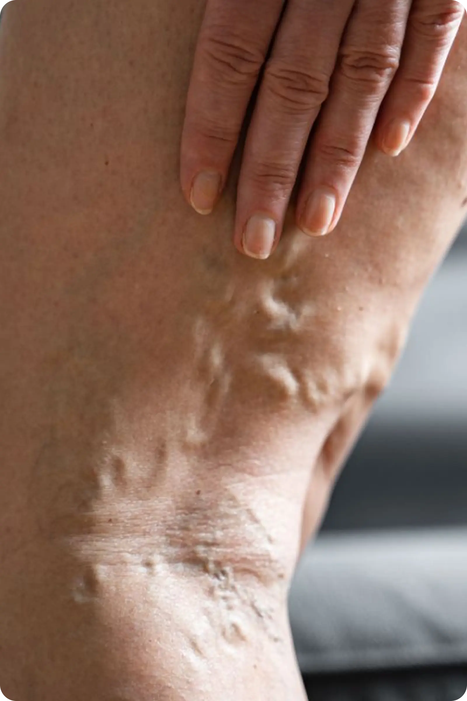 Varicose veins